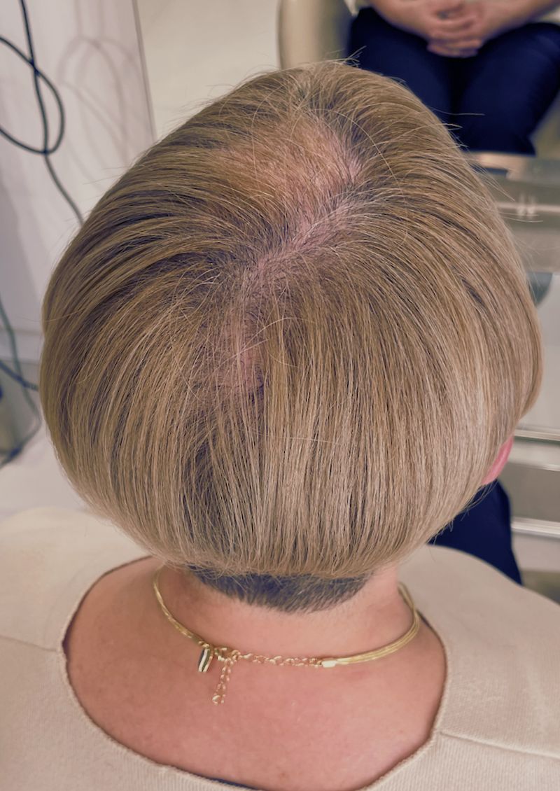 protesis capilares escasez cabello Prótesis capilares para la escasez de cabello